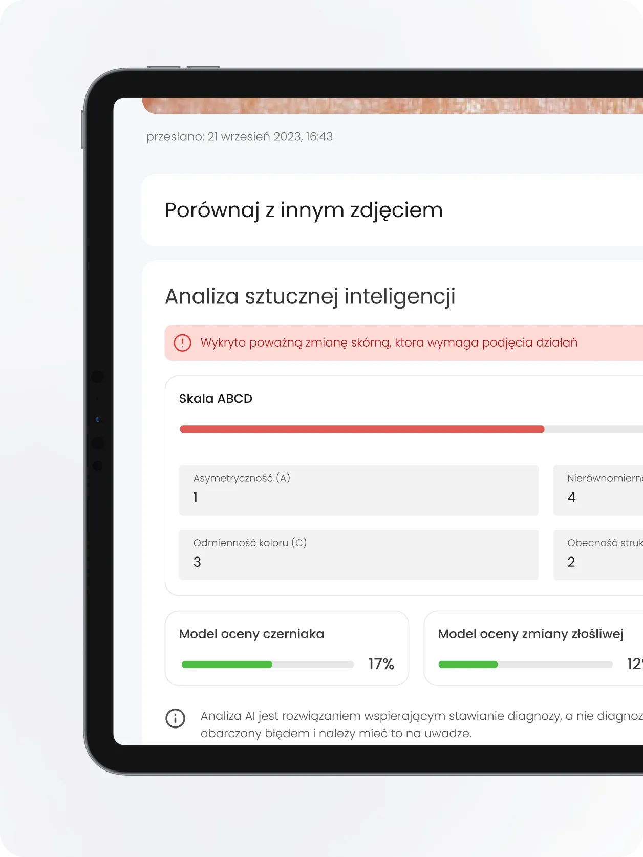AI analysis of a skin lesion photo on a tablet